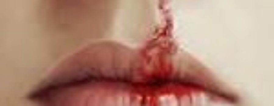 When The Nose Bleeds (Epistaxis)